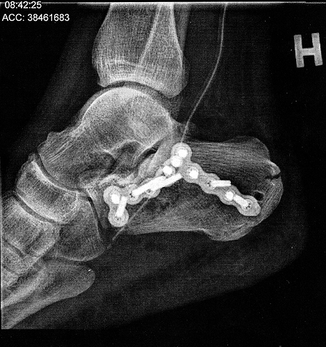 Calcaneus_01.jpg