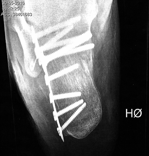 Calcaneus_02.jpg