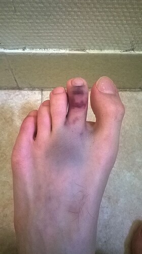 broken toe