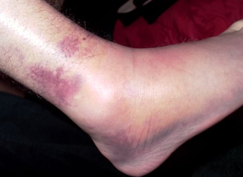 sore ankle day four.jpg