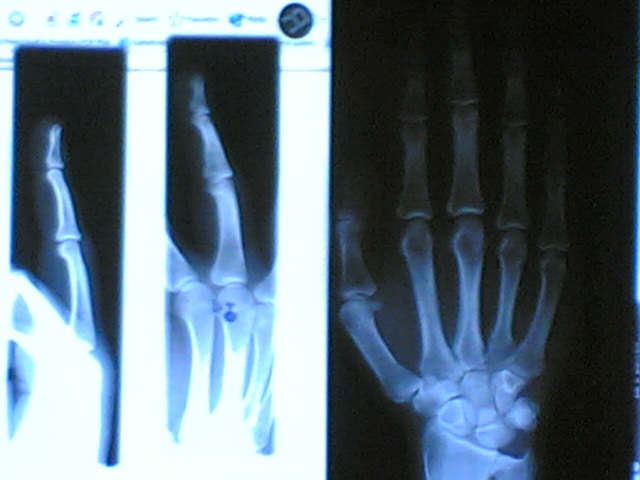 xray compr.jpg